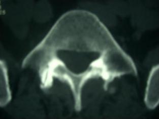 Bild einer Spondylarthrose (Facettenabnützung) im CT