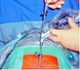 Bild von endoskopischer lumbaler Dekompression