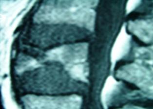 Bild von einer Osteoporose- Wirbeleinbruch mit Pseudarthose