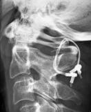 Bild einer hintere Fusion 1./2.Halswirbel bei rheumatischer Instabilität mit Beckenkammspan und Cerclagen