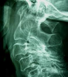 Bild einer rheumatische Halswirbelsäule- pseudobasiläre Impression+ “Stufenleiter- HWS“