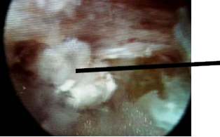 Bild von eines vorgefallenen Bandscheibengewebes im Endoskop