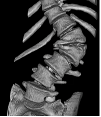 Bild von 2 wedge vertebrae severe progression