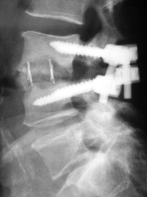 Bild einer Bandscheibenausräumung und Stabilisierung von hinten bei Spondylitis
