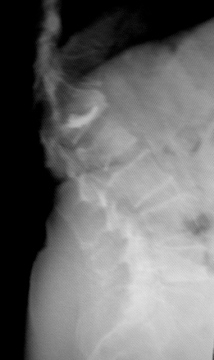 Bild einer Kyphose nach osteoporotischen Wirbeleinbrüchen