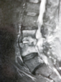 Bild einer Spondylitis im MRI