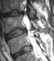 Bild einer Synovialcyste im MRI