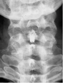 Bild einer operativen Therapie des cervikalen Vorfalls: Versteifung 5./6.Halswirbel nach Ausräumung eines Bandscheibenvorfalls