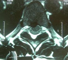 Bild eines Bandscheibenvorfalls in der Brustwirbelsäule