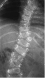 Bild von combined deformities, spine out of balance classification of congenital kyphosis