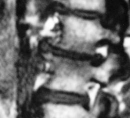 Bild von einer erosive Osteochondrose