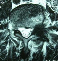 Bild von einer Foramenstenose L4/5 links