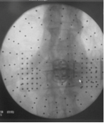 Bild von intraoperativem Röntgenbild