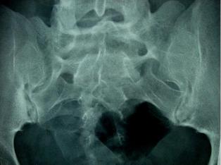 Bild von einer Spondylarthritis unterer Kreuzdarmbeingelenkanteile