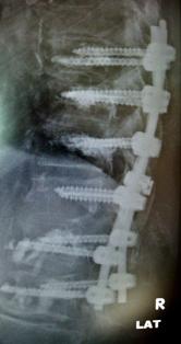 Bild einer Osteoporose-88jähriger Patient, hintere Aufrichtung und Instrumentieru
