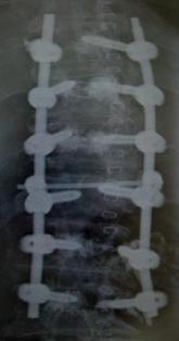 Bild einer Osteoporose-88jähriger Patient, hintere Aufrichtung und Instrumentierung mit zementierten Schrauben