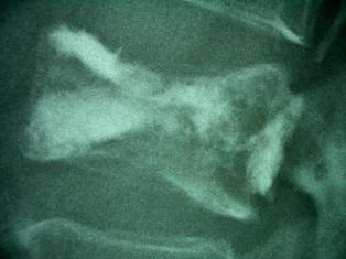 Bild einer Osteoporose-Pseudarthrose nach WK-Einbruch-Z.n.Vertebroplastie
