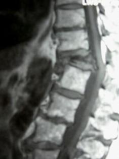Bild einer Osteoporose-88jähriger Patient, Wirbeleinbruch mit zunehmender Querschnittslähmung