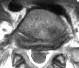 Bild von Spondylolisthese (Wirbelgleiten) 5.Lendenwirbel, breite Vorwölbung der Bandscheibe L5/S1 („Bulging disc“)