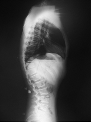Bild von Abb.1 Scheuermannbedingte Keilwirbelbildung mit Kyphose im Bereich des Überganges Brust-Lendenwirbelsäule