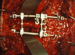 Bild einer Tumor-Ewing-Sarkom 4.BWK- Z.n.Resektion, Harms-käfigabstützung und Stabilisierung von hinten