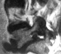 Bild von Foramenstenose durch die vorgewölbte Bandscheibe bei Spondylolisthese