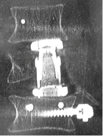 Bild instabiler Lendenwirbelbruch, Stabilisierung von hinten, Freilegung der Nerven, Teilresektion des gebrochenen Wirbelkörpers und Wirbelersatz durch Titankäfig von vorne